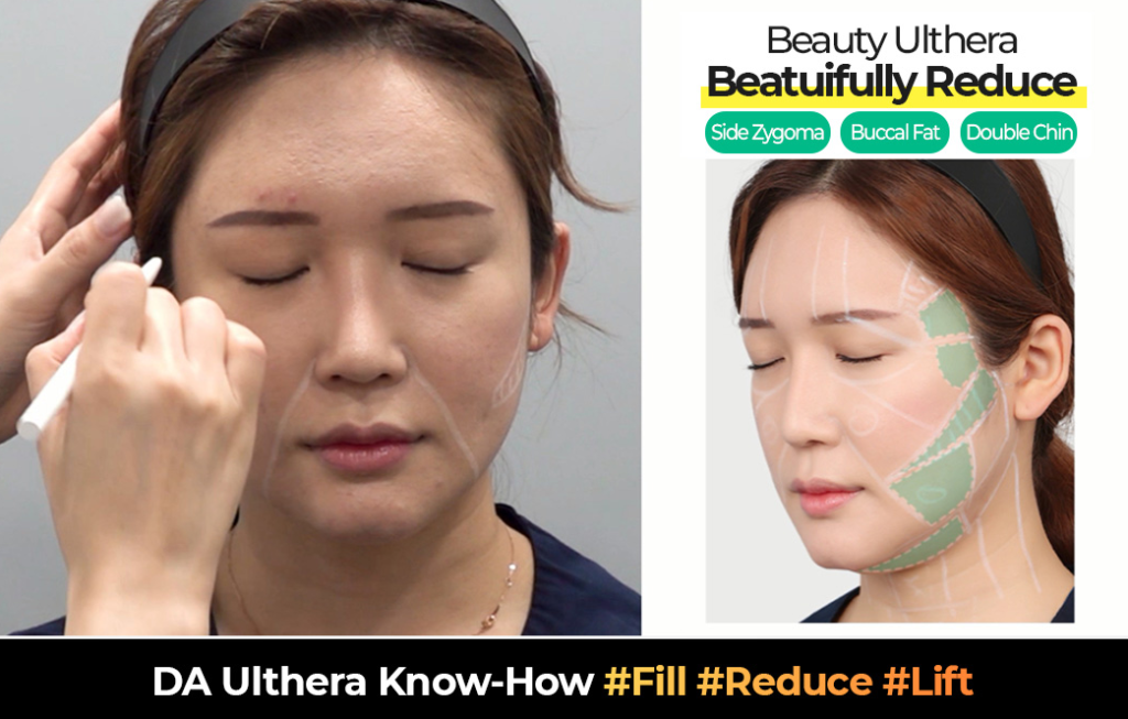 Ultherapy